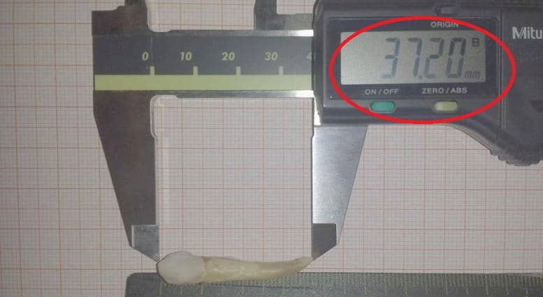 طبيب اسنان يدخل "غينيس" بعد خلع أطول سن