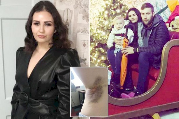   ممرضة بريطانية تتفاجأ بكدمات غريبة على جسدها.. وبعد أيام كانت المأساة