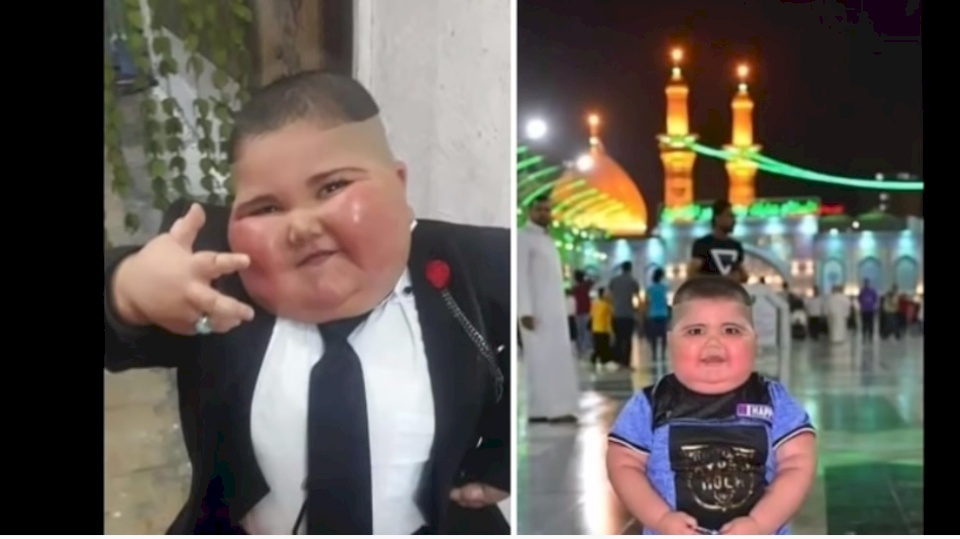 هل توفي الطفل العراقي الشهير "حسوني" بسبب السمنة المُفرطة؟