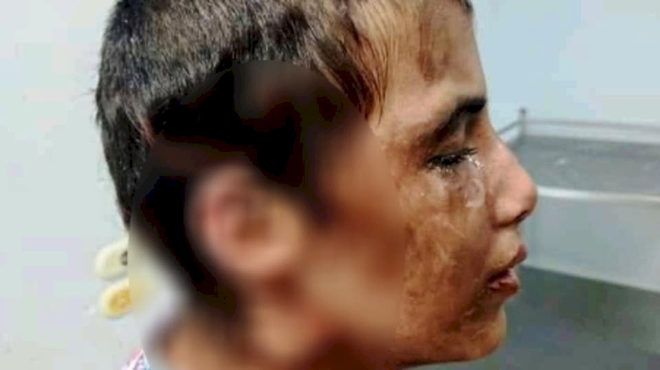 صور: طفلة مصرية تتعرض لتعذيب وحشي على يد الأسرة التي تعمل لديهم