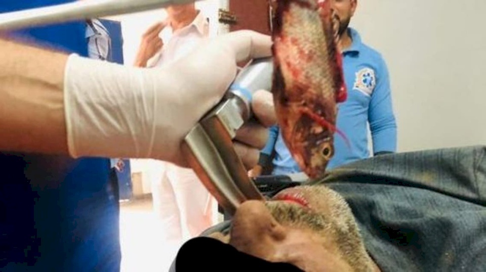 حدث فعلاً.. استخراج سمكة حية من القصبة الهوائية لصياد مصري