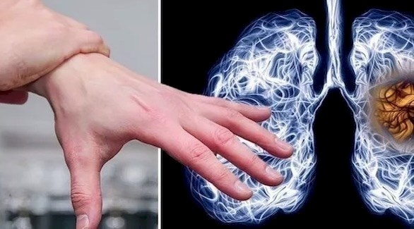 تضخم الأصابع .. مؤشر على الإصابة بسرطان الرئة