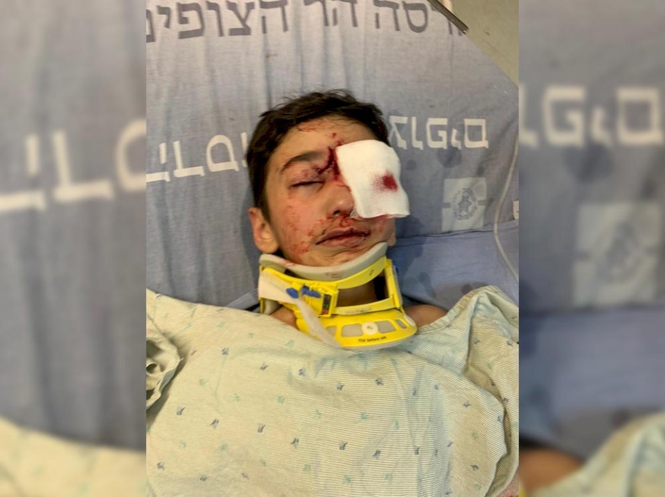 فقأ عينه.. الاحتلال يغلق التحقيق بإطلاق النار على طفل مقدسي