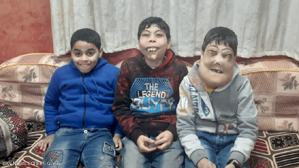 "اخلع القناع".. معاناة طفلين مصريين مع المرض النادر!