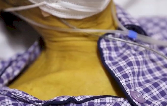 صور- رجل صيني يفاجئ الأطباء بعد تحول جلده إلى اللون الأصفر