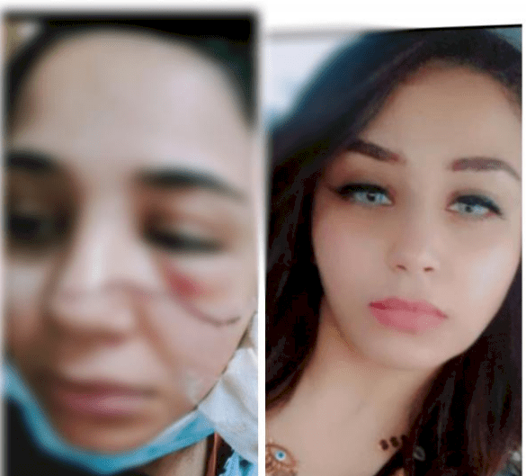 رفضت عريس شقيقتها فشوه وجهها: "أختي هربت معاه وتجوزته"
