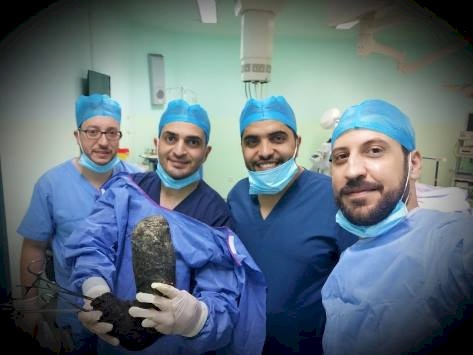 إزالة 6 كغم شعر من بطن فتاة أردنية