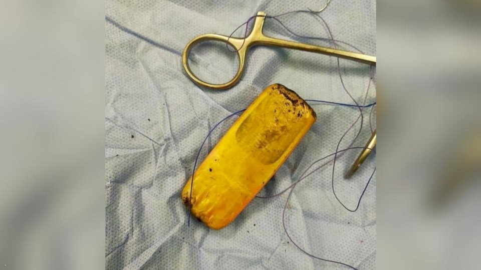 استخراج هاتف محمول من بطن مريض بمصر.. تعرف على القصة!