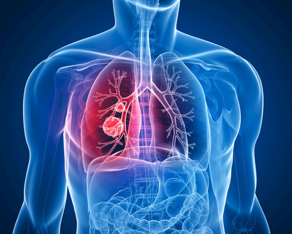الصحة: 70% من مرضى سرطان الرئة في فلسطين هم من المدخنين والمدخنين السابقين