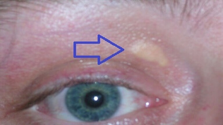ماذا يعني ظهور لويحات حول العين؟