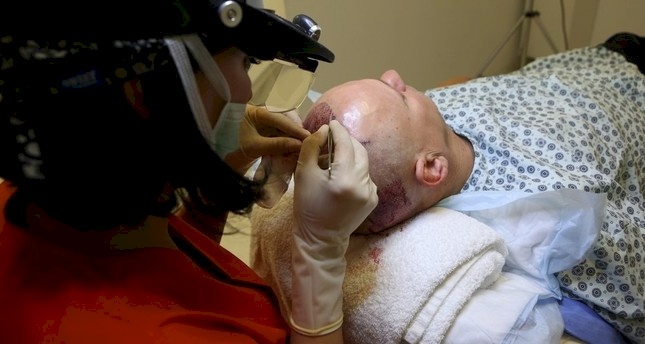 خلال 6 أشهر.. أكثر من نصف مليون شخص أجروا عمليات زراعة شعر في تركيا