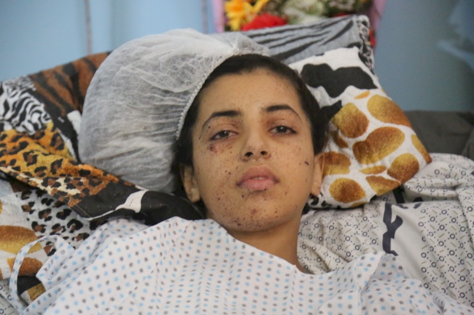 خاص- الطفلة رهف فقدت أطرافها في العدوان على غزة ولم تفقد الأمل 
