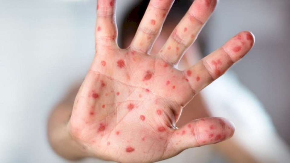 تسجيل أول اصابة بمرض جدري القردة في الأردن