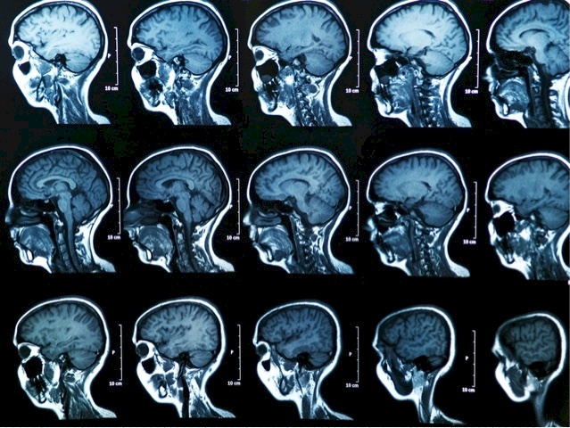 التصوير بالرنين المغناطيسي يكشف عن تشوهات كبيرة في الدماغ بعد التعافي من كورونا!