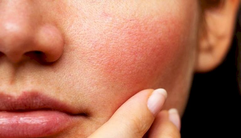 Lactic Acid as a Retinoid Alternative for Sensitive Skin Care