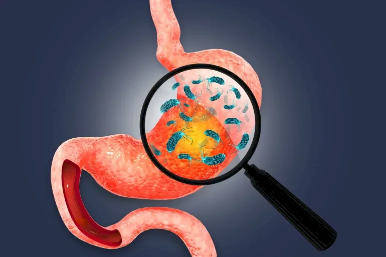 Accurate Diagnosis and Complex Treatment: How Do We Combat Stomach Bacteria?