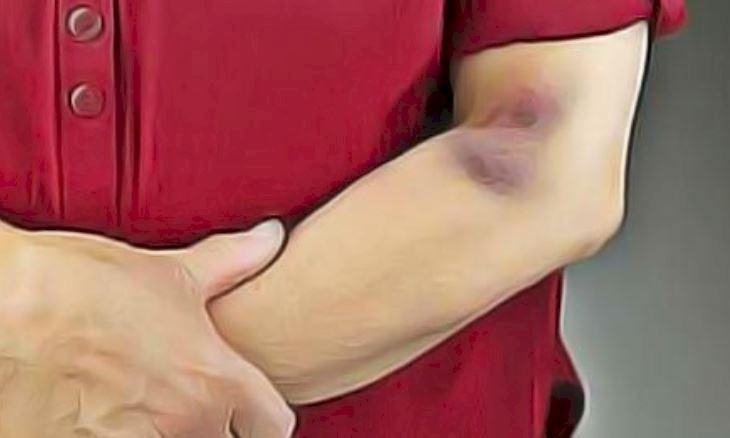 ما هي أسباب الكدمات المتكرِّرة في الجسم؟