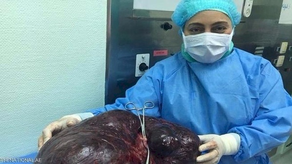 إزالة ورم يتجاوز 17 كيلوغراماً من بطن امرأة إماراتية